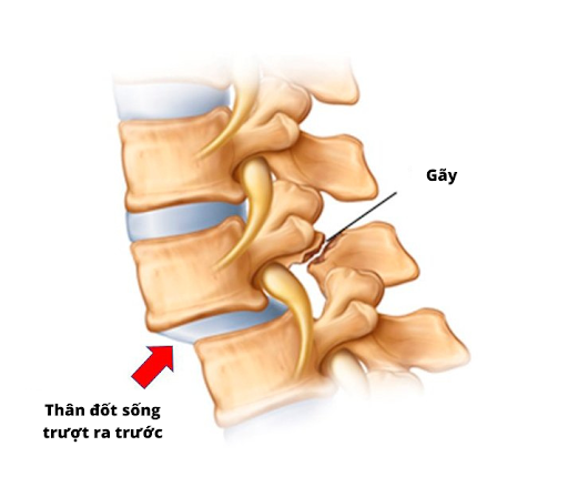 Causes of low back pain in middle-aged women